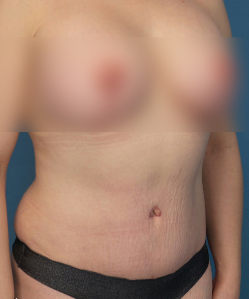 after tummy tuck right view female patient case 1947