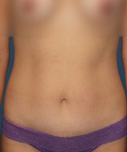 after tummy tuck front view female patient case 1959