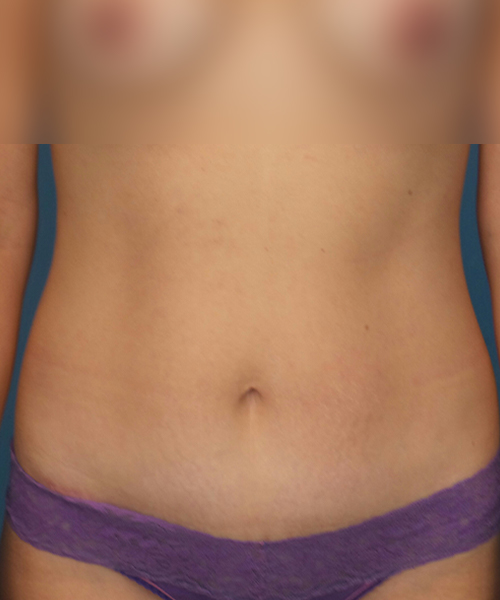 after tummy tuck front view female patient case 1959