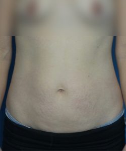 before tummy tuck front view female patient case 1959