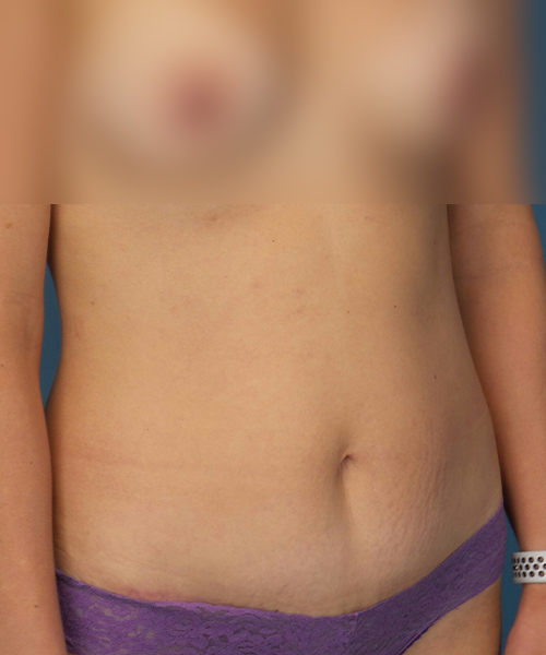 after tummy tuck right view female patient case 1959