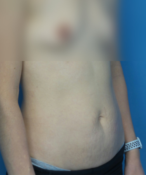 before tummy tuck right view female patient case 1959
