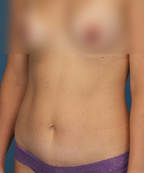 after tummy tuck left view female patient case 1959