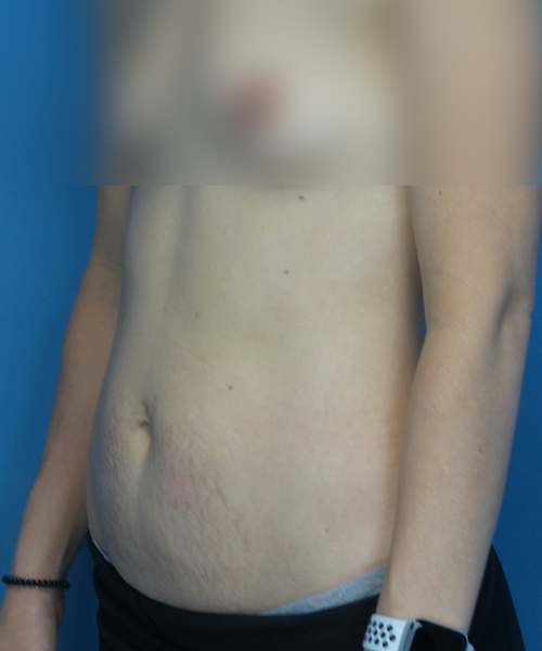 before tummy tuck left view female patient case 1959