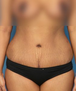 after tummy tuck front view female patient case 1966