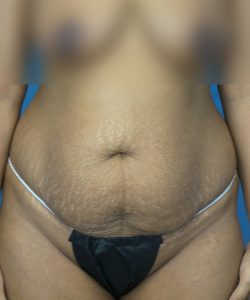 before tummy tuck front view female patient case 1966
