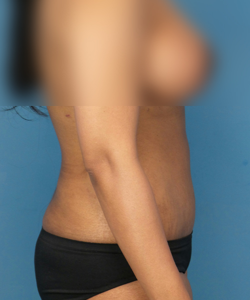 after tummy tuck right side view female patient case 1966
