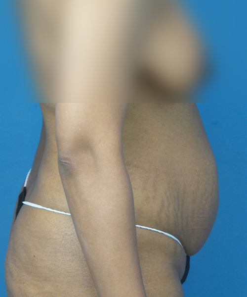 before tummy tuck right side view female patient case 1966