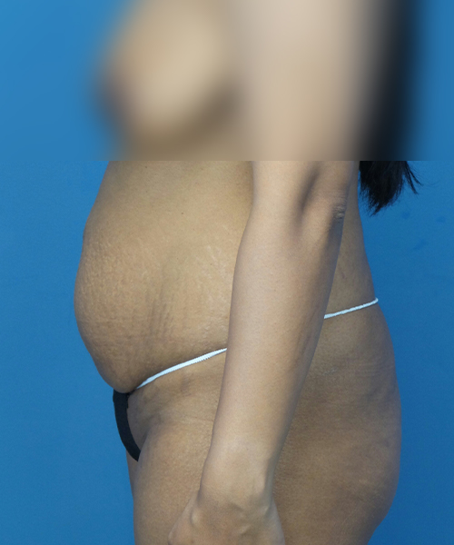 before tummy tuck left side view female patient case 1966