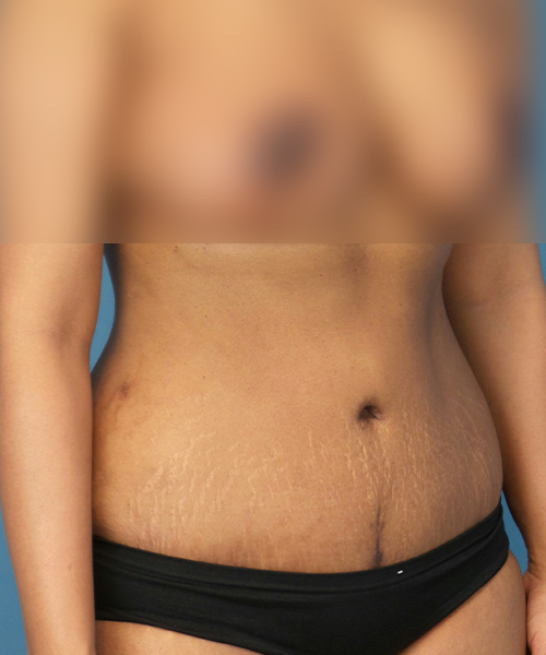 after tummy tuck right view female patient case 1966