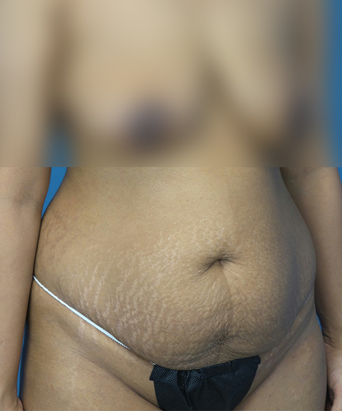 before tummy tuck right view female patient case 1966