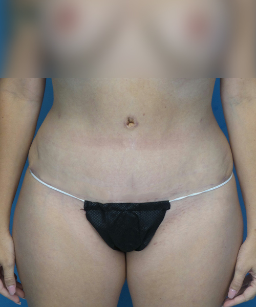 after tummy tuck front view female patient case 1975