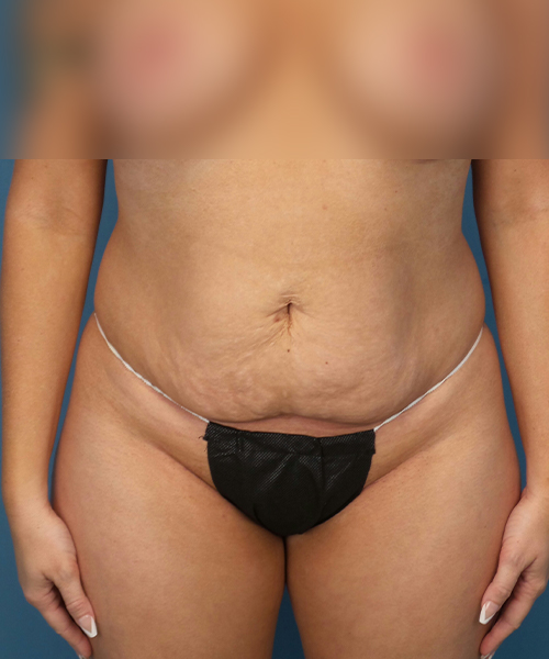 before tummy tuck front view female patient case 1975