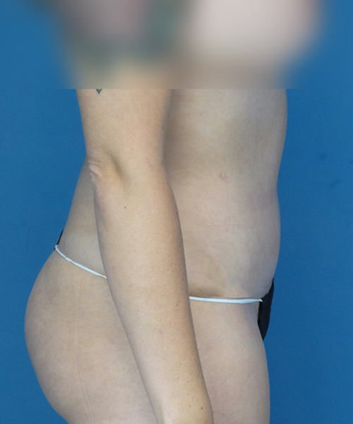 after tummy tuck right side view female patient case 1975