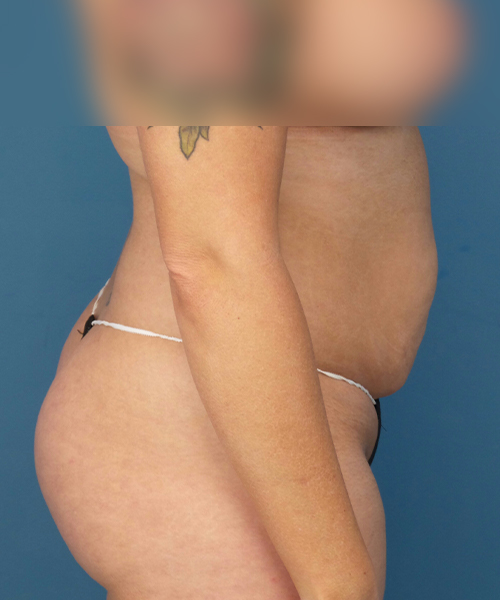 before tummy tuck right side view female patient case 1975
