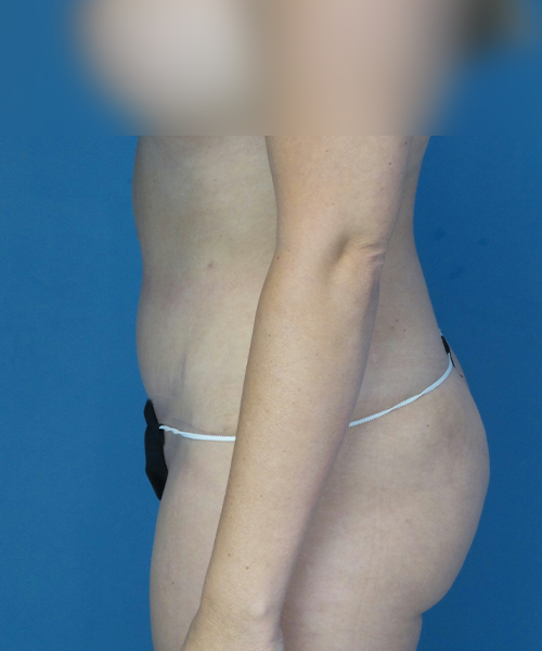 after tummy tuck left side view female patient case 1975