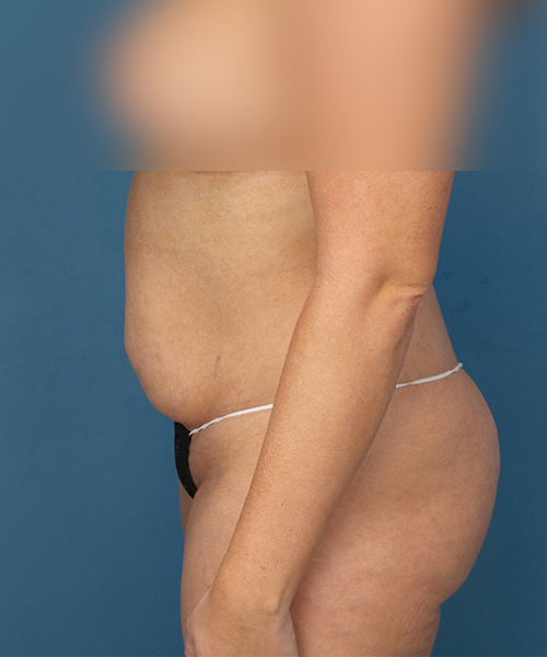 before tummy tuck left side view female patient case 1975