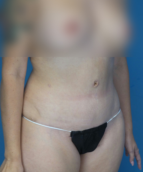 after tummy tuck right view female patient case 1975