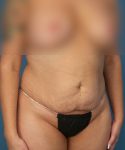 before tummy tuck right view female patient case 1975