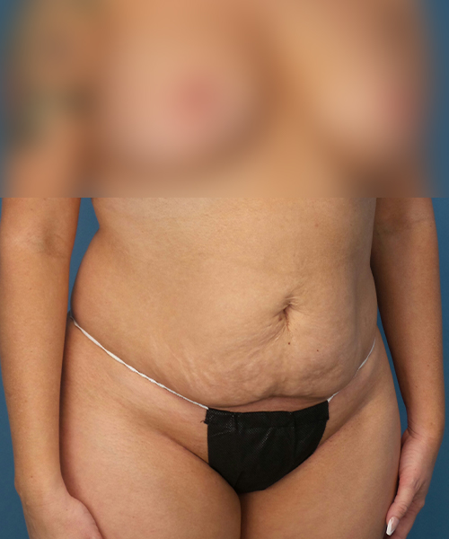 before tummy tuck right view female patient case 1975