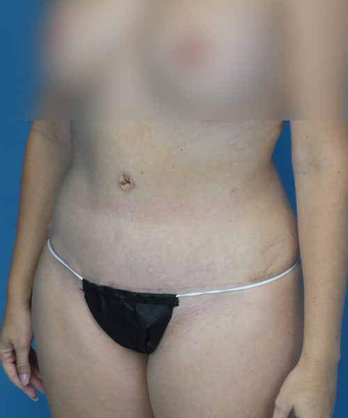 after tummy tuck left view female patient case 1975