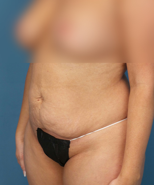 before tummy tuck left view female patient case 1975