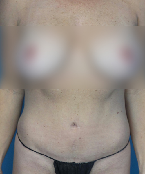 after tummy tuck front view female patient case 1986
