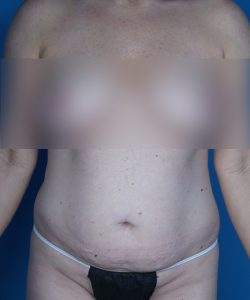 before tummy tuck front view female patient case 1986