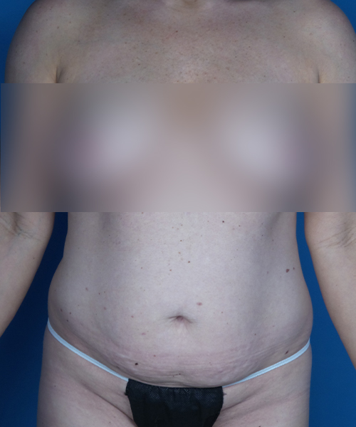 before tummy tuck front view female patient case 1986