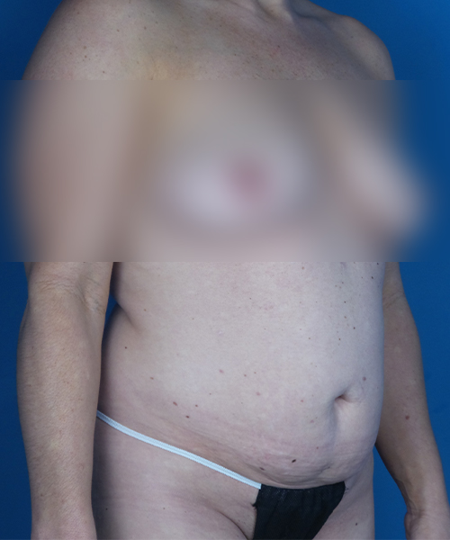 before tummy tuck right view female patient case 1986