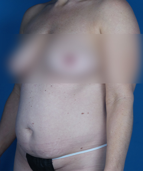 before tummy tuck left view female patient case 1986