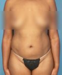 before tummy tuck front view female patient case 1997