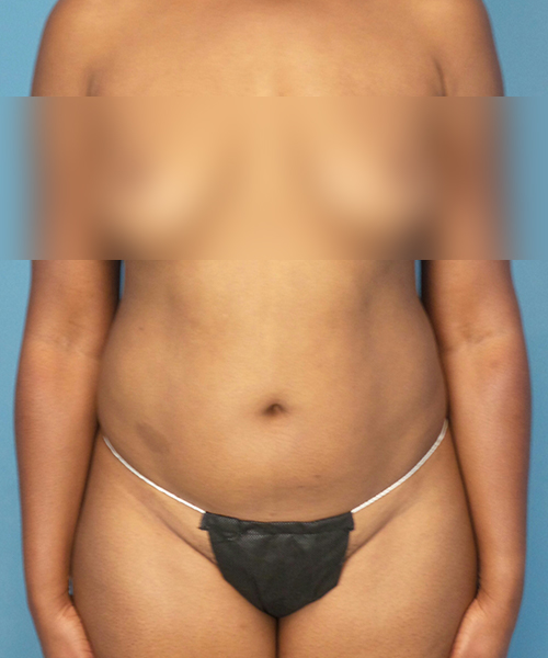 before tummy tuck front view female patient case 1997