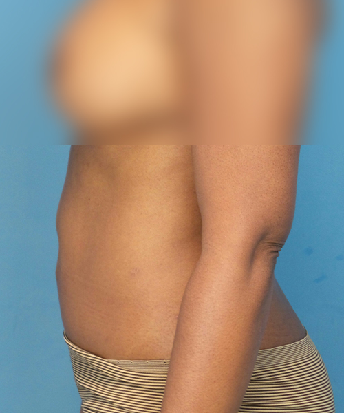after tummy tuck left side view female patient case 1997