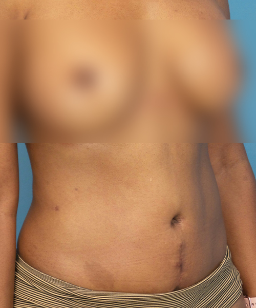 after tummy tuck right view female patient case 1997