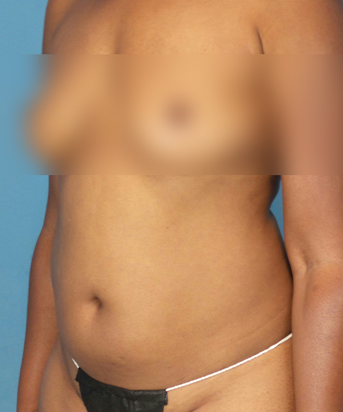 before tummy tuck left view female patient case 1997