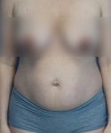 before tummy tuck front view female patient case 2008