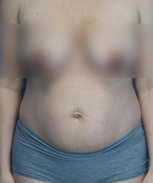 before tummy tuck front view female patient case 2008