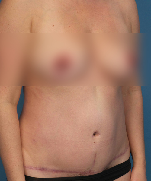 after tummy tuck right view female patient case 2008