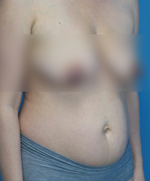 before tummy tuck right view female patient case 2008
