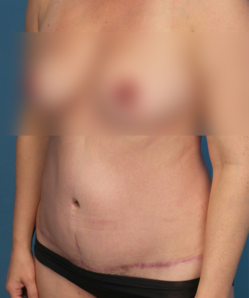 after tummy tuck left view female patient case 2008