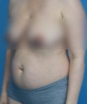 before tummy tuck left view female patient case 2008