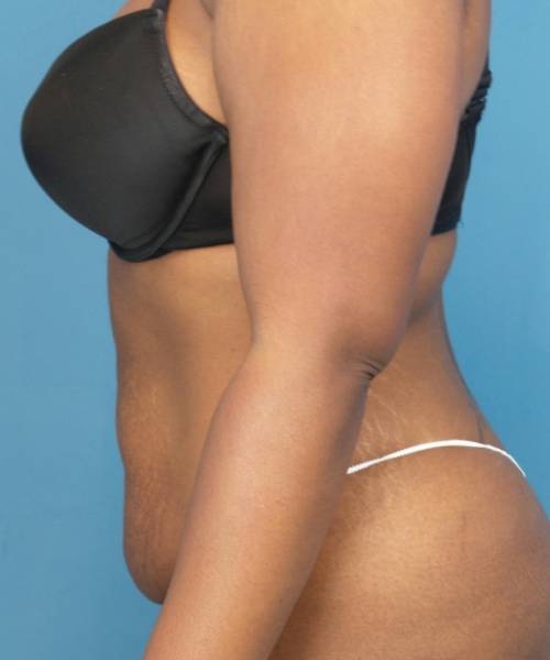 before tummy tuck left view case 3675 | Crispin Plastic Surgery Atlanta, GA