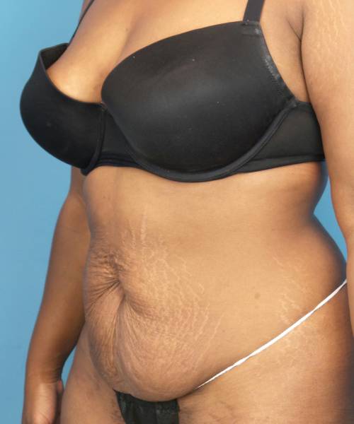 before tummy tuck left diagonal view case 3675 | Crispin Plastic Surgery Atlanta, GA
