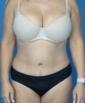 after tummy tuck front view female patient case 3686