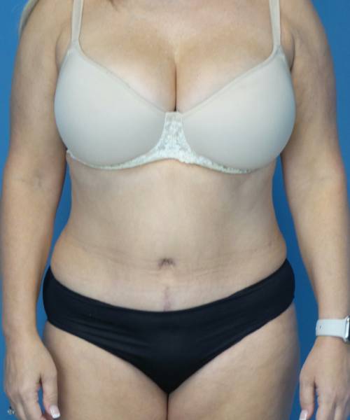 after tummy tuck front view female patient case 3686