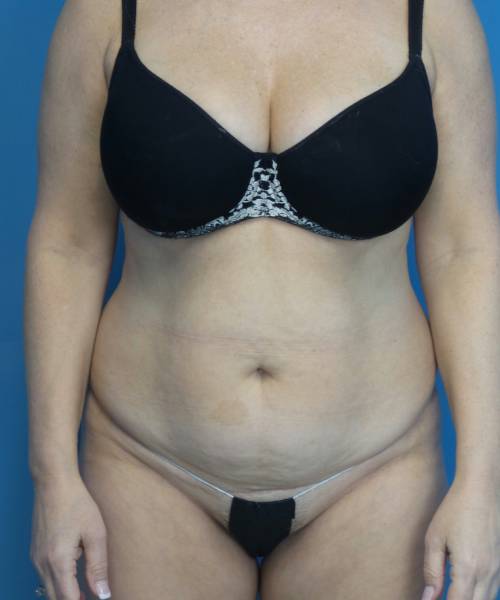 before tummy tuck front view female patient case 3686