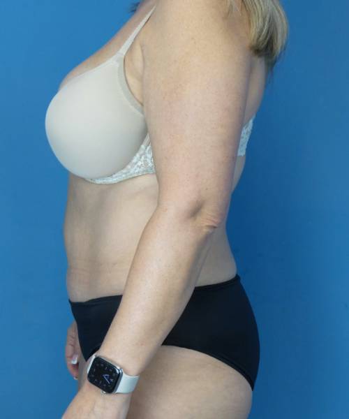 after tummy tuck left side view female patient case 3686