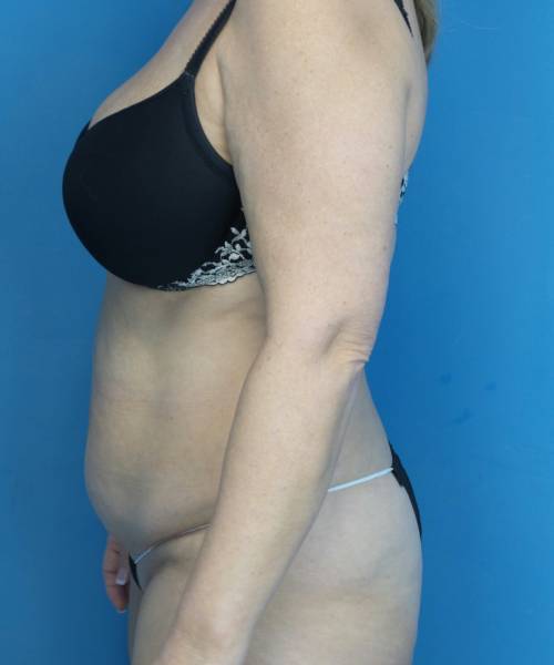 before tummy tuck left side view female patient case 3686