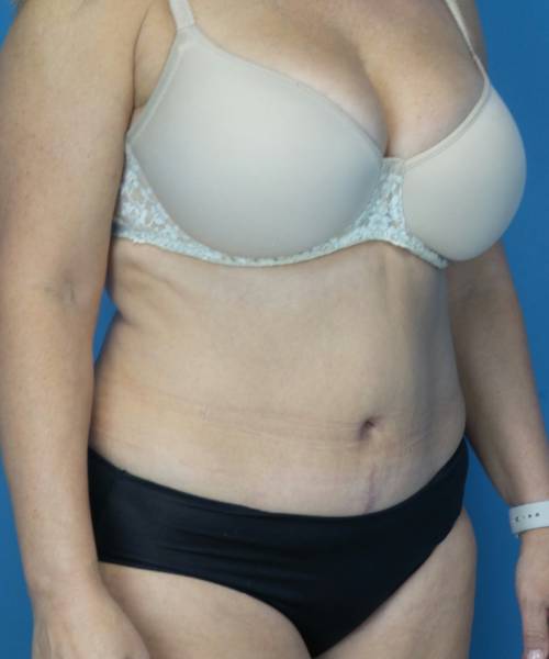after tummy tuck right view female patient case 3686